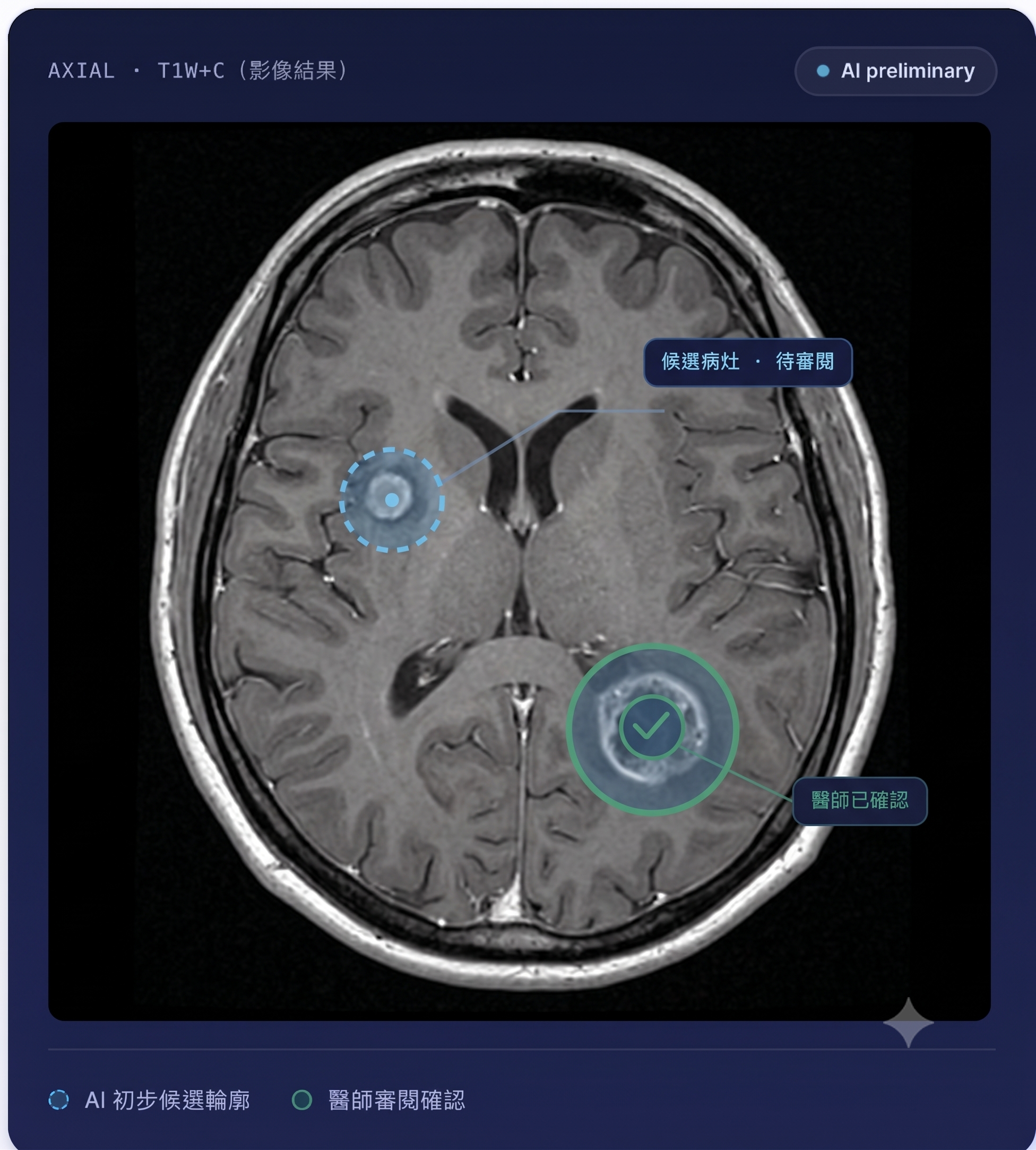 AI-assisted lesion-level MRI review visualization with preliminary candidate contours and physician-confirmed lesion